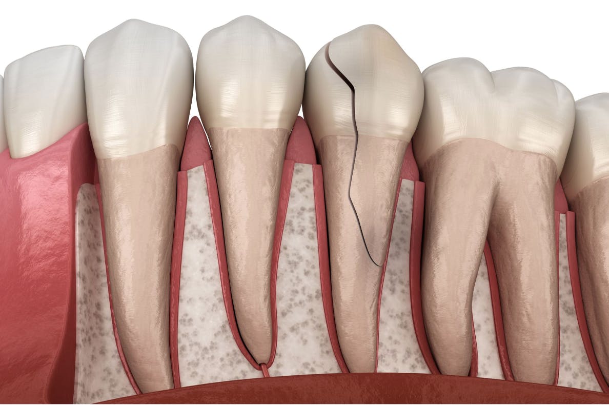 Advanced Dental Singapore Root Canal Treatment