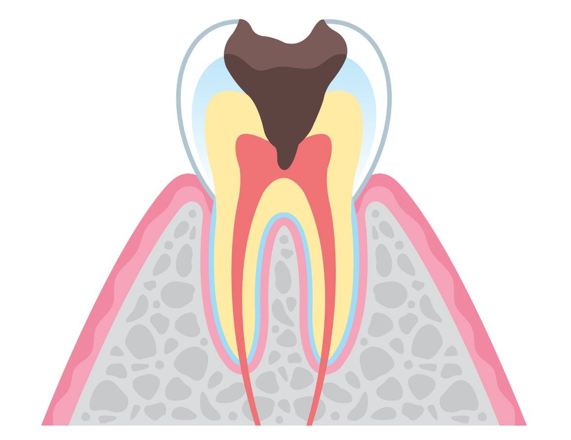 Advanced Dental Singapore | Root Canal Treatment